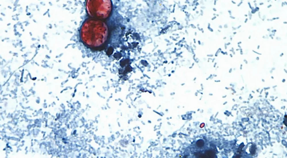 FDA Says Cyclospora Outbreak Linked to Recalled Iceberg Lettuce Has Reached 20 States, With 11,458 Illnesses and Two Deaths Reported in Michigan