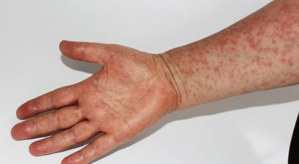 Dallas County Health Officials Confirm One Measles Case and Warn North Texans About Possible Exposure at Three Allen Fairview and Frisco Locations in August
